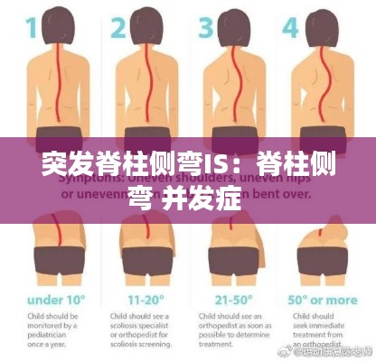 突发脊柱侧弯IS：脊柱侧弯 并发症 